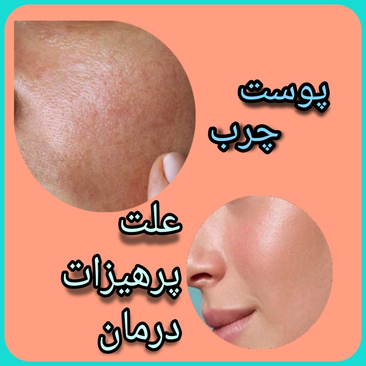 چربی پوست را چطور از بین ببریم؟