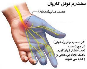 خاصیت درمانی روغن سیاهدانه در بیماری سندروم تونل کارپال 